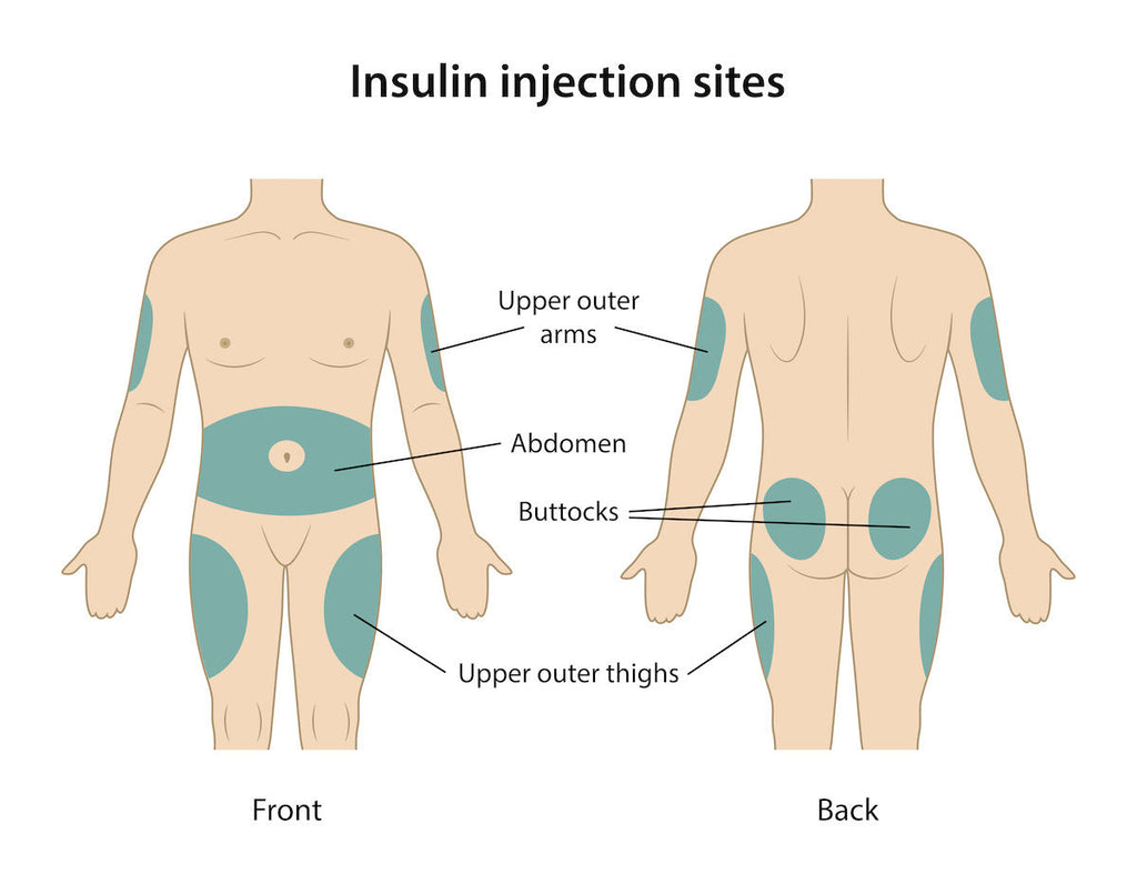 Schémas des sites d'injection de l'insuline